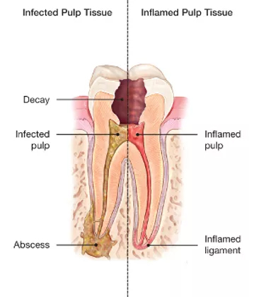 Root Canal Edingburgh