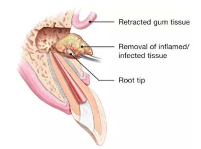 apicoectomy