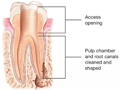 Root Canal Access Opening