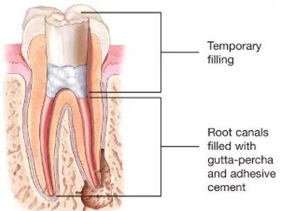 Root Canal Filling