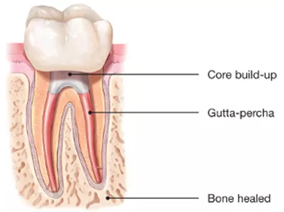 Root Canal Healed