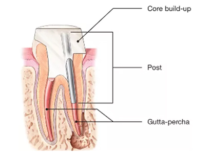 Root Canal Post